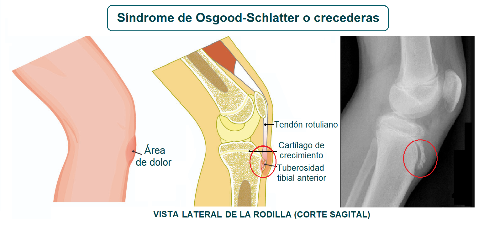 Crecederas Osgood-Schlatter