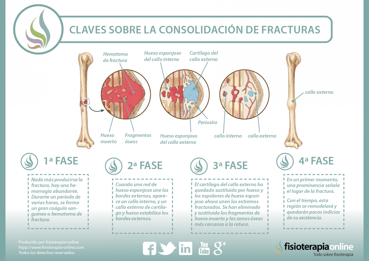 ¿Cómo cura nuestro organismo una fractura o fisura ósea?