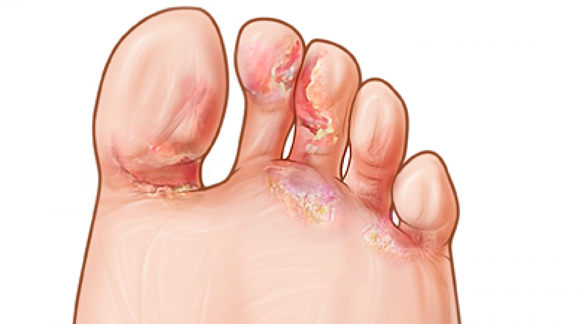 ampollas dolorosas en los pies
