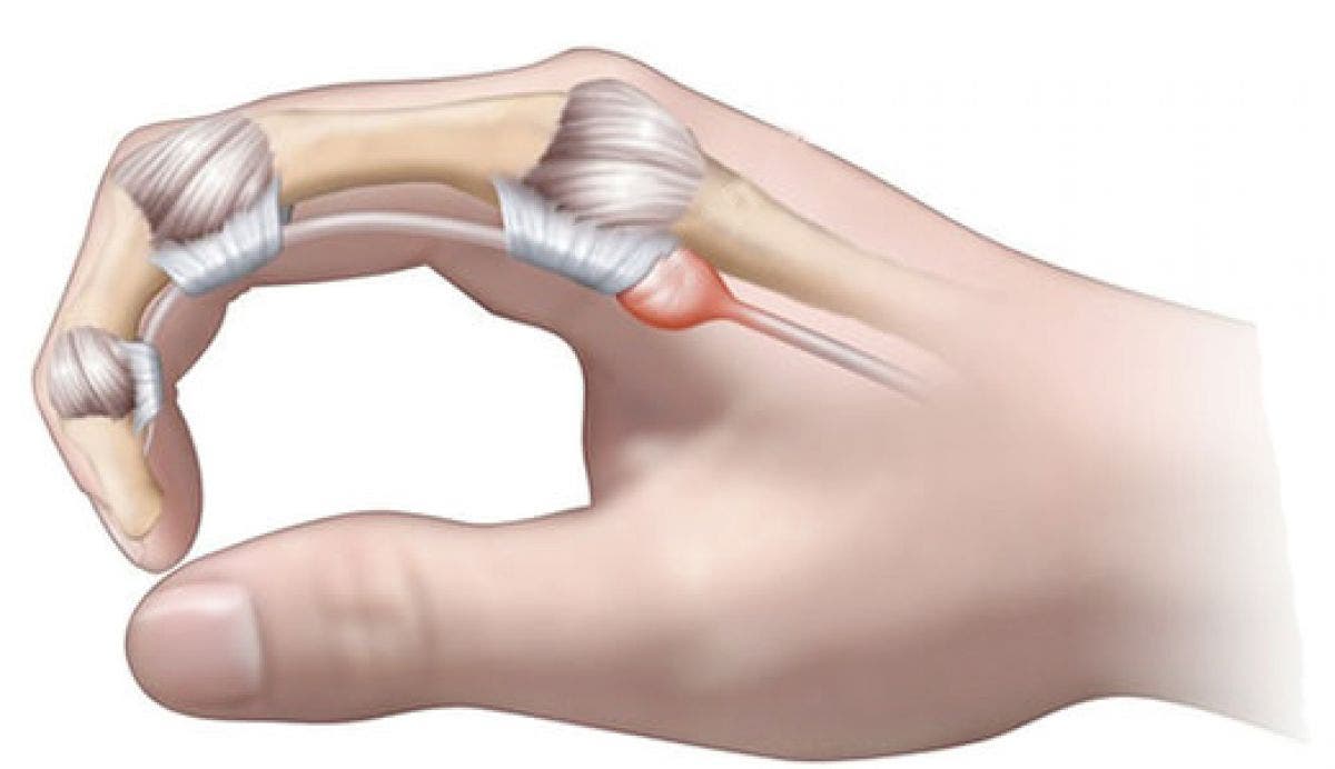 tendinitis en el dedo indice dela mano derecha
