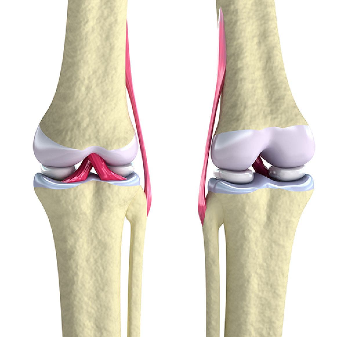 rotura de ligamento cruzado anterior recuperacion sin cirugia