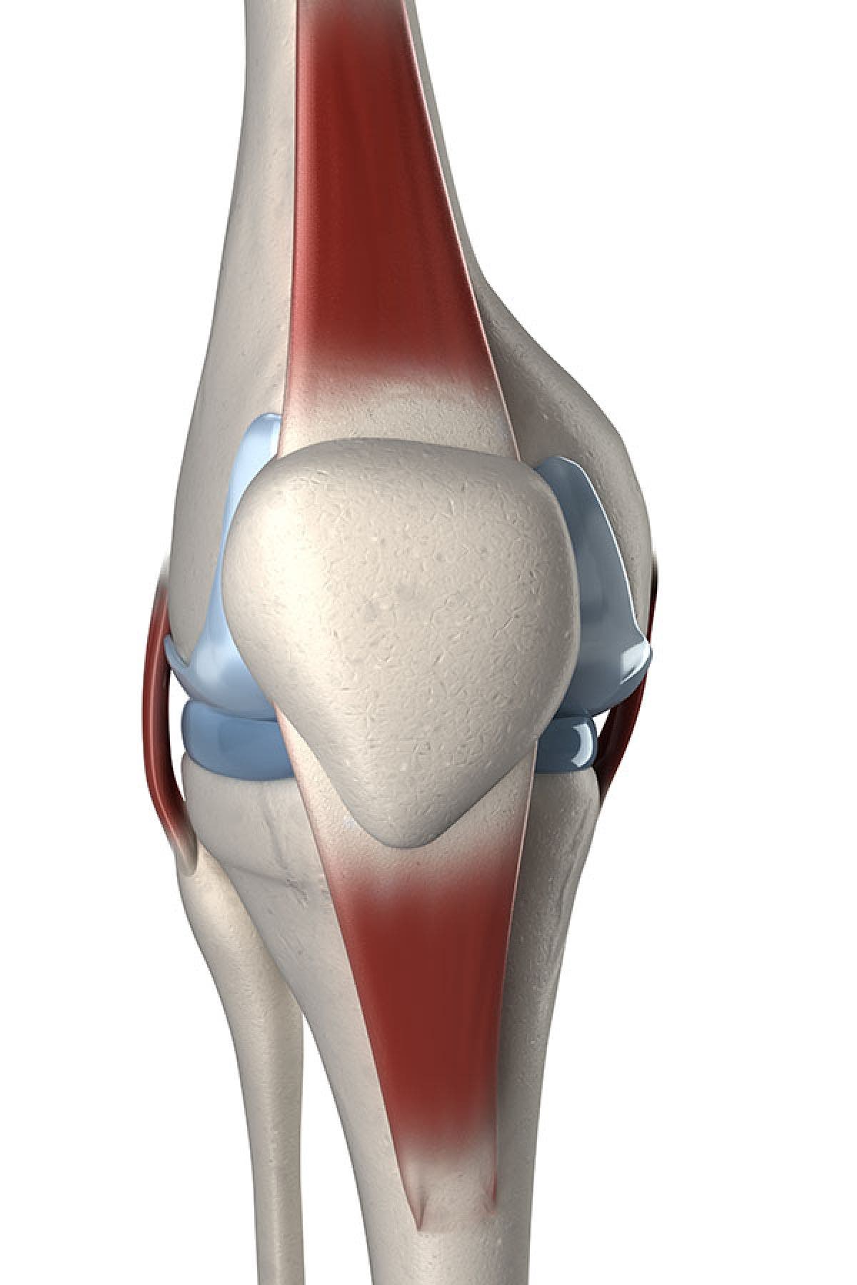 tratamiento+para+tendinitis+rotuliana+cronica