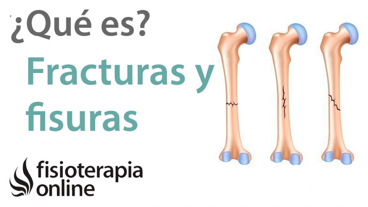 dolor en la ingle durante la recuperación de la fusión