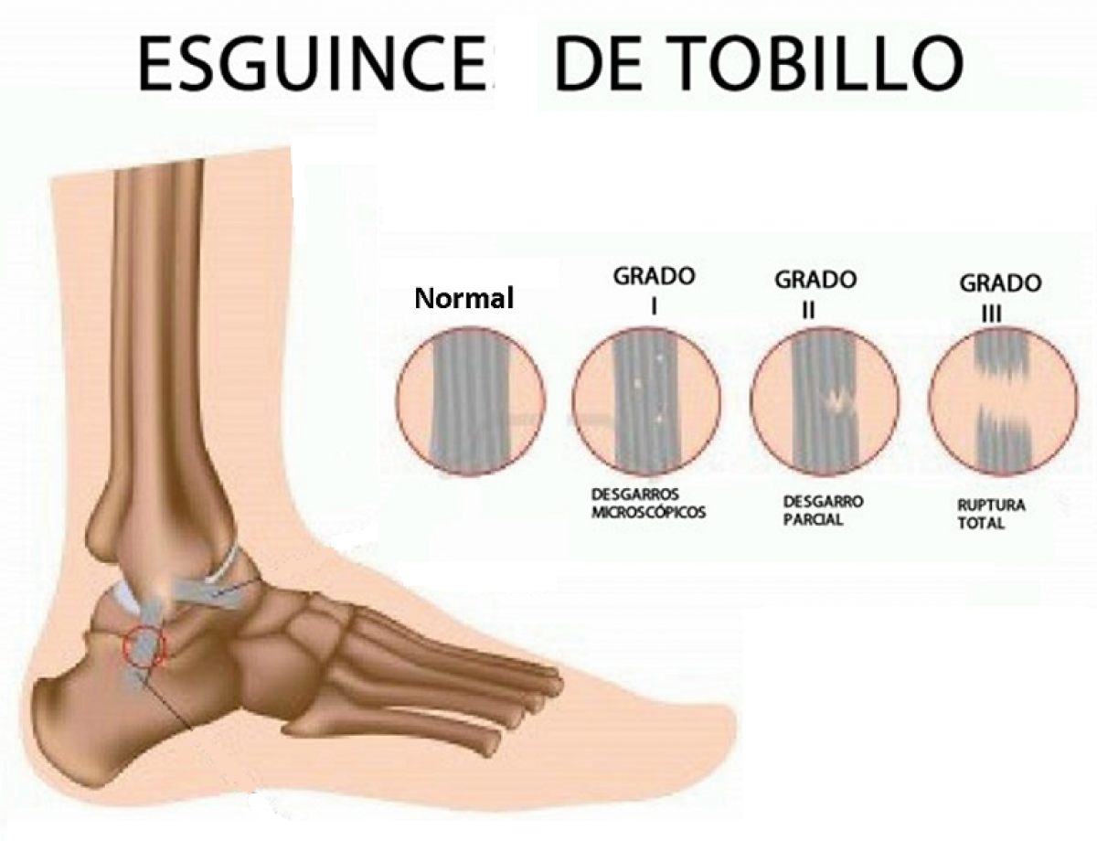 Resultado de imagen de entorsis tobillo