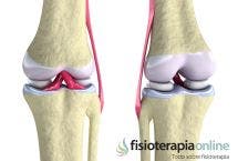 ¿Qué es una hernia discal lumbar? Síntomas, causas y ¿Qué es una hernia discal lumbar? Síntomas, causas y