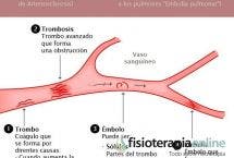 Trombosis o embolia