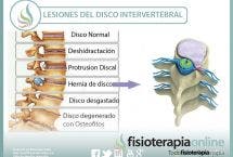 Lesiones más frecuentes del disco intervertebral