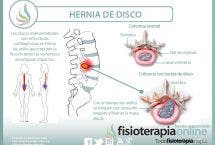 Conoce todo lo que necesitas saber sobre las hernias de disco, causas, consecuencias, síntomas y tratamiento desde la fisioterapia