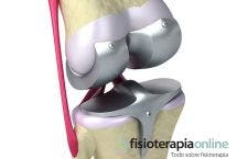 Todo lo que debemos saber sobre las prótesis de rodilla