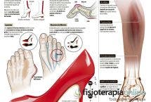 Consecuencias del abuso de los tacones. Daños en el tendón de Aquiles, juanetes, dedo martillo, neuroma de Morton