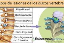 Las vértebras cervicales suelen sufrir lesiones, una de ellas es la hernia discal cervical descubre como y porque ocurre