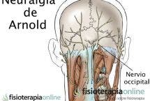 Neuralgia u occipitalgia de Arnold. Descubre sus causas, consecuencias y tratamiento