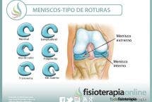 No hay dos rodillas iguales, ni dos lesiones de menisco iguales, aprende algunas diferencias