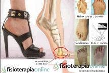 Metatarsalgias y juanetes por el uso de tacones