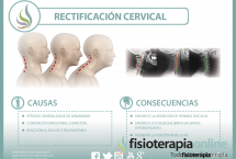 La rectificación cervical, una disfunción en auge, descubre qué es y a que se debe