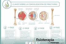 ¿Sabes cómo se consolidan o recuperan las fracturas de huesos? Descubre cómo ocurre