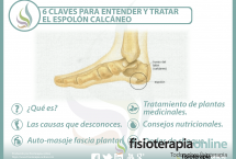 6 claves para entender y tratar el espolón calcáneo