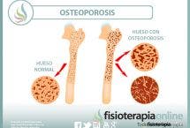 Explicando la osteoporosis