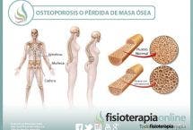 La osteoporosis o pérdida de masa ósea. Un grave problema de los huesos
