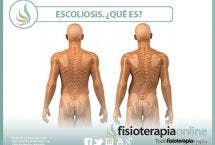 Escoliosis ¿Qué es? Tipos, causas y tratamiento