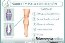 Varices, el castigo de la circulación