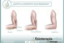 Descubriendo la bursitis olecraniana