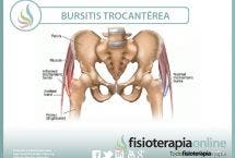 Conoce la bursitis trocantérea o trocanteritis