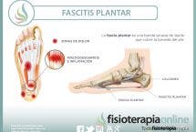 Fascitis plantar. Qué es, cuáles son sus causas y cómo podemos tratarla