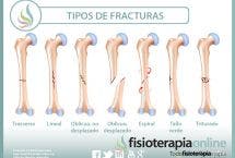 Fracturas óseas, tipos, cuidados y tratamiento