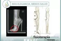 Más elegancia, menos salud. Cuidado con el abuso de los tacones, pueden facilitar problemas de espalda y alterar la correcta postura corporal