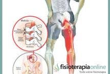 Síndrome piramidal y atrapamiento del nervio ciático, todo lo que necesitas saber