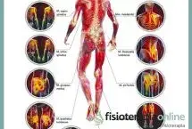 Puntos gatillo de la zona dorsal, los causantes musculares de la dorsalgia
