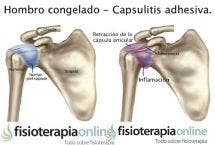 Hombro congelado o capsulitis adhesiva, unos útiles consejos e información para que sepas cómo afrontarlo