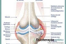 Artrosis, degeneración del cartílago articular, una serie de recomendaciones, reflexiones y consejos sobre el tema