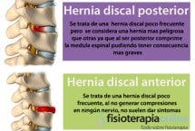 Las hernias discales pueden ser muy diferentes, aprende cómo son algunas de ellas