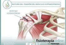 Rotura del  tendón del músculo supraespinoso, información y consejos para su prevención