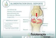 Conoce lo que supone una rotura de menisco, sus causas, consecuencias y tratamiento