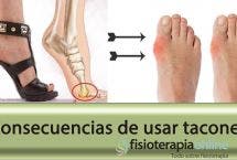 El juanete o hallux valgus, el castigo de la mujer con tacones