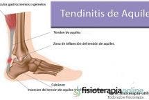 Tendinitis o tendinosis del tendón de Aquiles. Información, consejos y un útil automasaje
