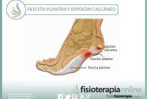 Fascitis plantar y espolón calcáneo, aprende lo que es y como se trata correctamente