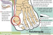 Hallux valgus o juanete, aprende un eficaz automasaje para tratarlo