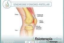 Tratamiento, características, síntomas, causas y mucho mas, sobre el síndrome femoro-patelar