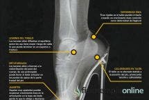 Juanetes, lesiones de tobillo, metatarsalgia, callosidades en el talón, deformidad ósea, consecuencia de los tacones