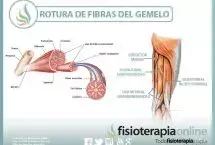Rotura de fibras del gemelo o gastrocnemio, una lesión frecuente