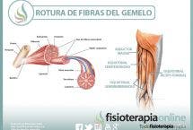 Rotura de fibras del gemelo o gastrocnemio, una lesión frecuente