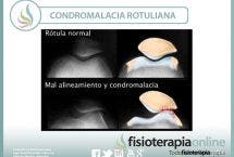 Condromalacia o condropatía rotuliana, causas, y tratamiento de una alteración mecánica