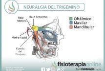Neuralgia del trigémino. Un problema complejo