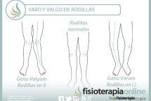 Rodillas varas o valgas. Dos alteraciones posturales y dos ejercicios para trabajarlas