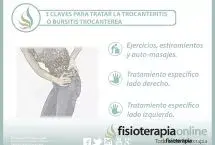 3 claves para tratar la trocanteritis o bursitis trocantérea