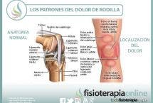 Los patrones del dolor de rodilla o gonalgia y las lesiones más comunes